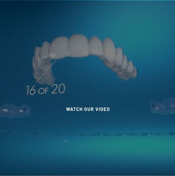 Digital model of Invisalign in Ludlow